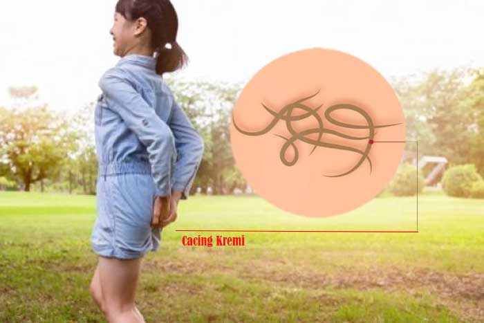 Mengenal Cacing Kremi dan Pengobatannya